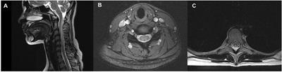 Nitrous oxide-induced neurotoxicity: Clinical characteristics and impacts on overall neurological impairments